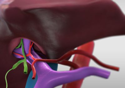 Чернодробна трансплантация: Лява латерална хепатектомия при жив донор (донор)